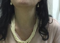 Tiroidectomia Cicatriz Minima En Medellin Colombia 02